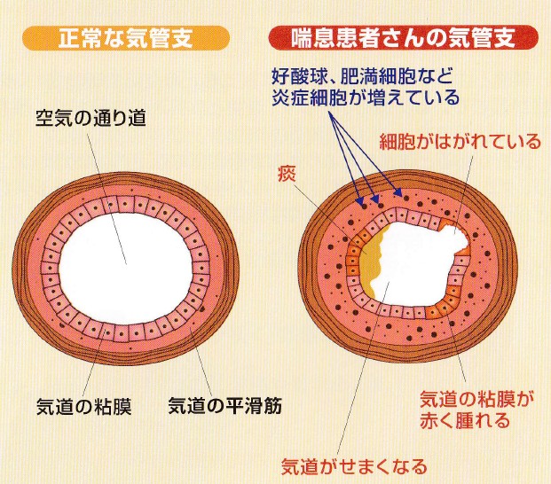 気道の炎症 気道の炎症