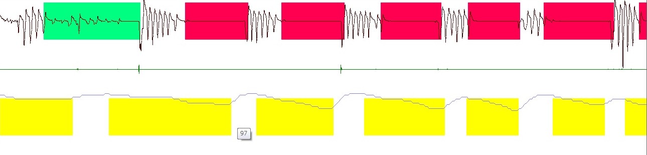 睡眠時無呼吸症候群の検査データ