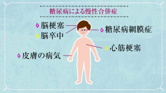 糖尿病合併症